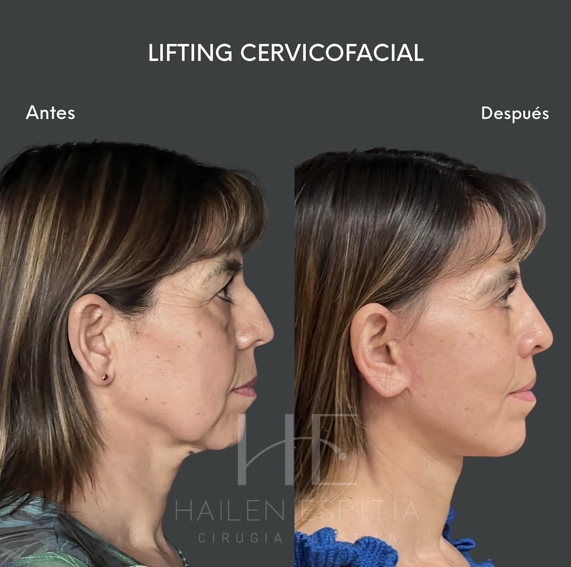 Lifting cervicofacial Perfil