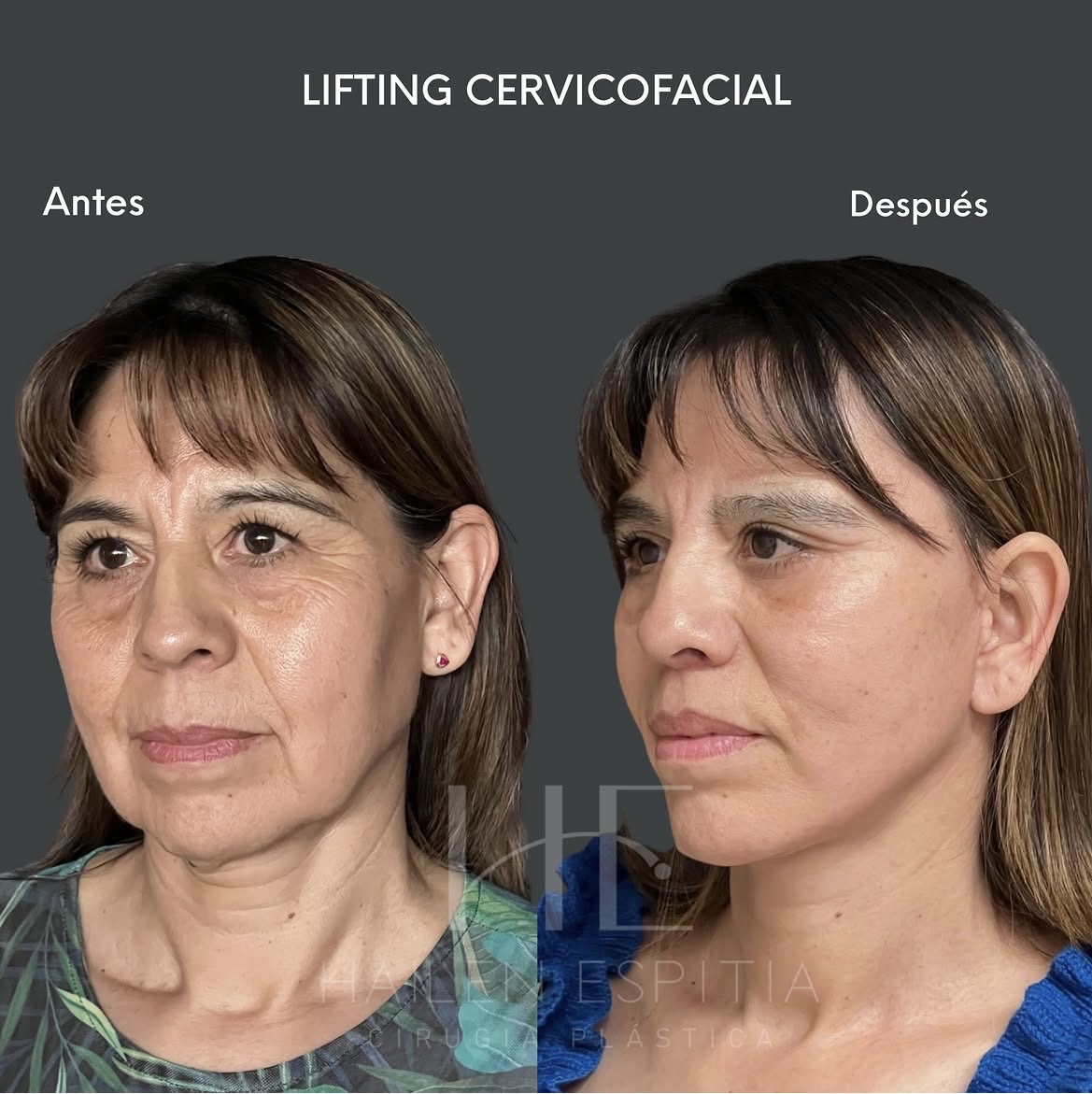 Lifting cervicofacial Vista 3/4