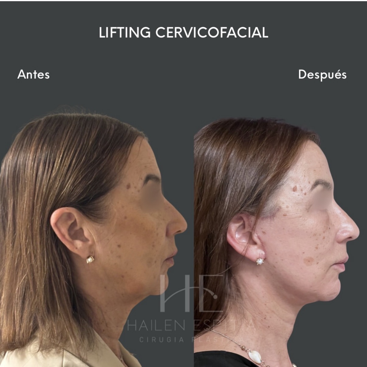 Lifting cervicofacial Perfil