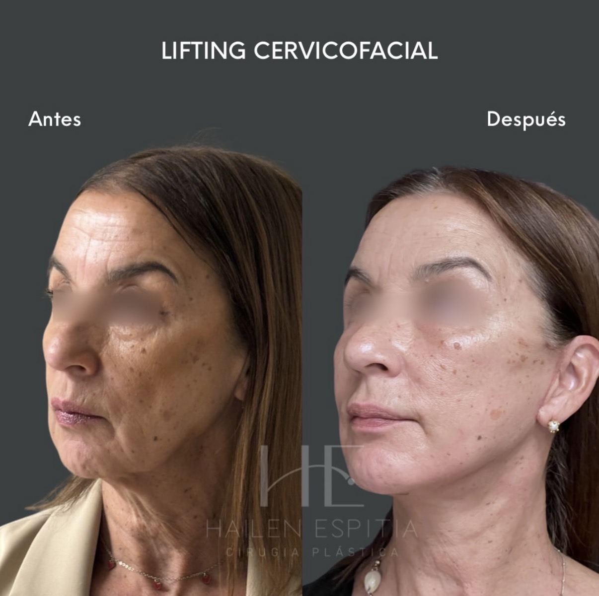 Lifting cervicofacial Vista 3/4