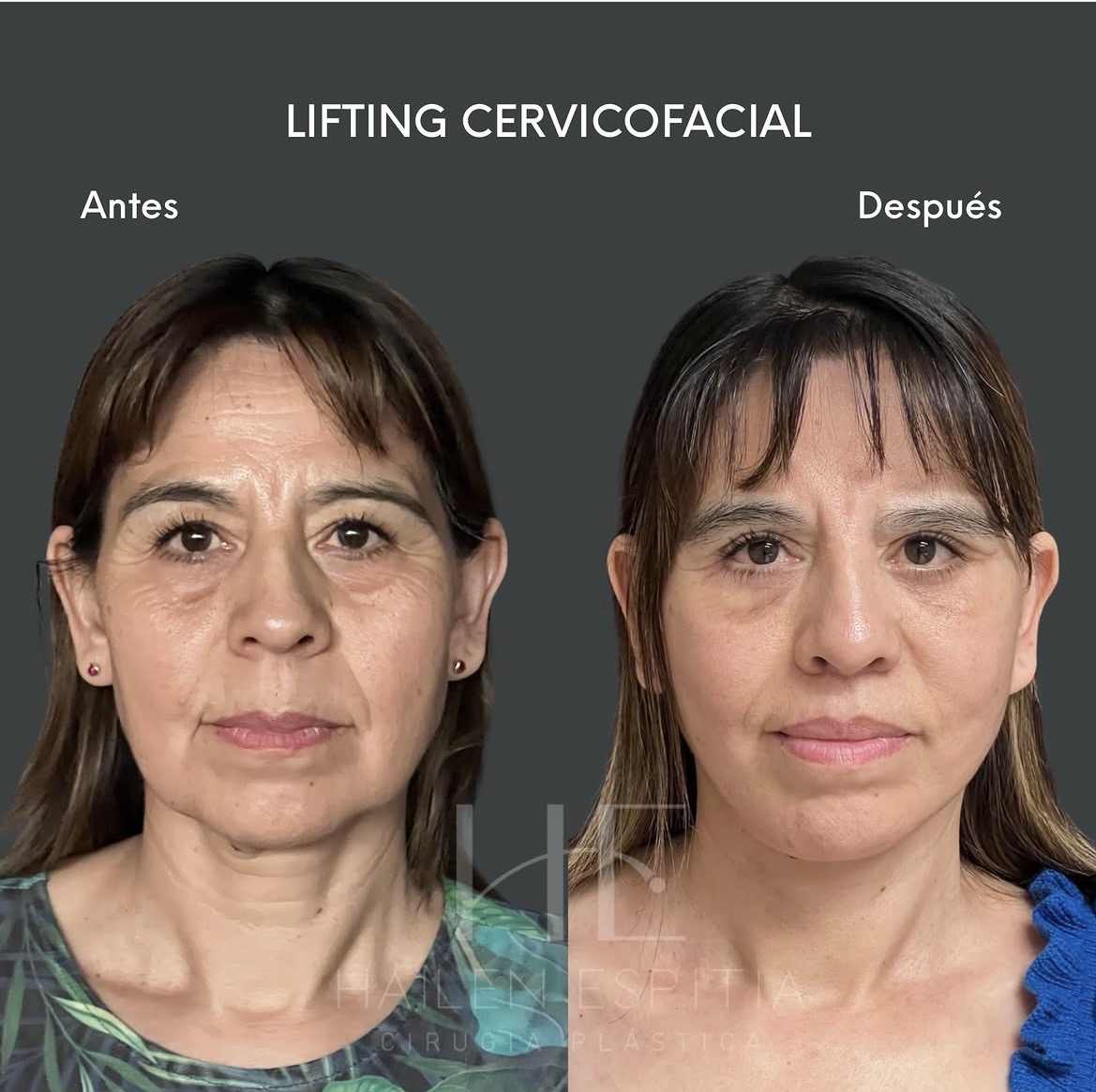 Lifting cervicofacial Vista frontal