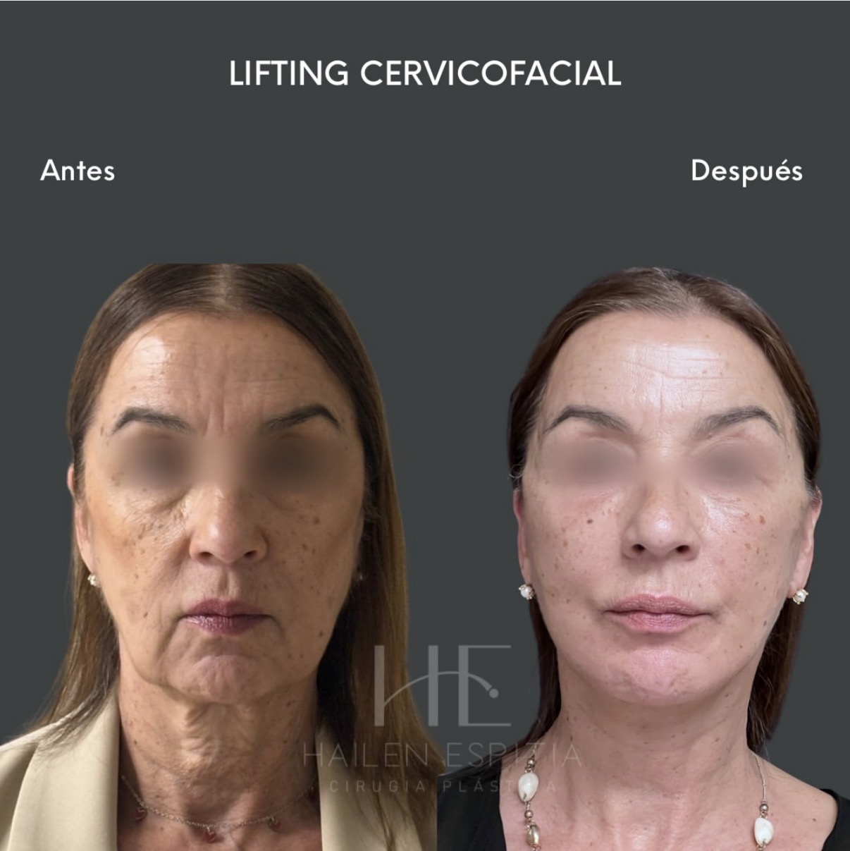 Lifting cervicofacial Vista frontal